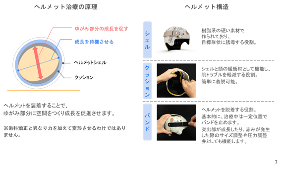 The image illustrates the concept and application of a helmet for orthodontic treatment, showing its role in promoting growth of the deformed part, providing cushioning, and facilitating easy removal.

AI 生成コンテンツは誤りを含む可能性があります。